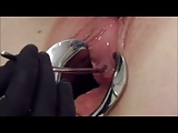 Female Urethral Sounding